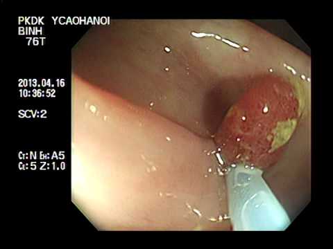Cắt polyp đại tràng Qua Nội Soi | Colonoscopic Polypectomy