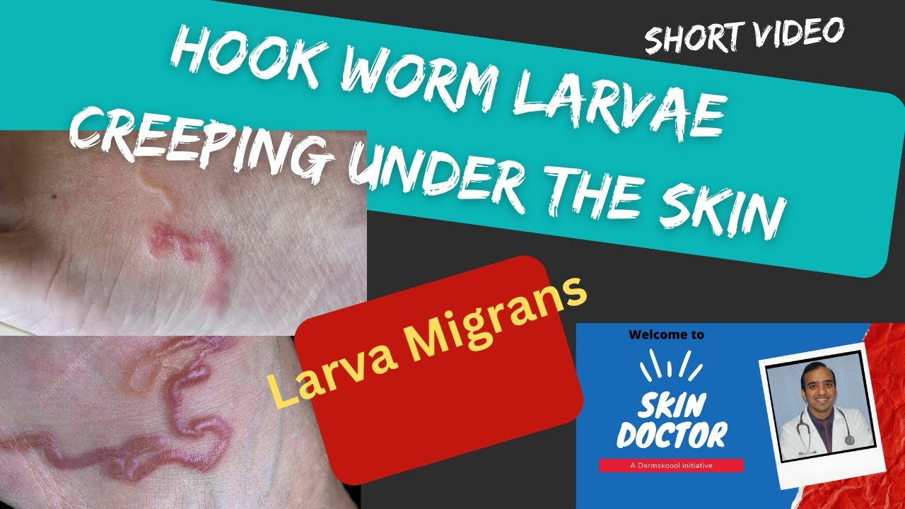 CUTANEOUS LARVA MIGRANS A Disease Caused By Hookworm Larvae Found In cutaneous-larva-migrans-a-disease-caused-by-hookworm-larvae-found-in