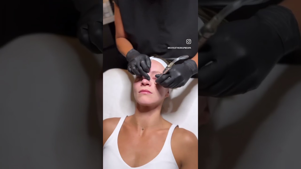 Microdermabrasion Benefits