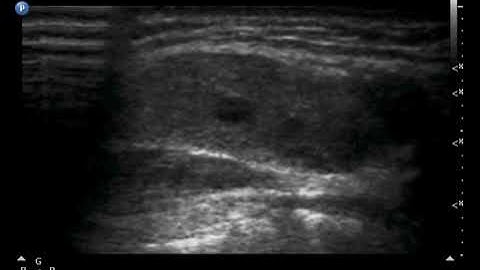 Cine loops in Ultrasonographic Verification of Lymphatic Malformation of the Neck: B-mode V 1