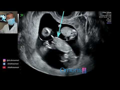 Video: Na implantaciji koliko ste sedmica trudni?