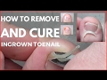 How to remove and cure ingrown toenail.