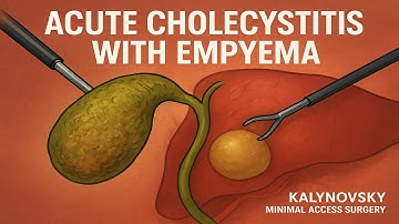 Acute Cholecystitis with Empyema. Laparoscopic Cholecystectomy– Critical View of Safety