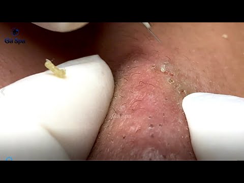 Cyst Squeezed to The Last Blob