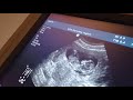 Я беременна!!!УЗИ на 12 неделе. Как выглядит малыш на УЗИ в 12 недель ❤️первый скрининг