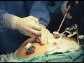 Watch the Gastric Band Surgery Video