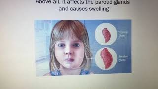 Mumps Presentation