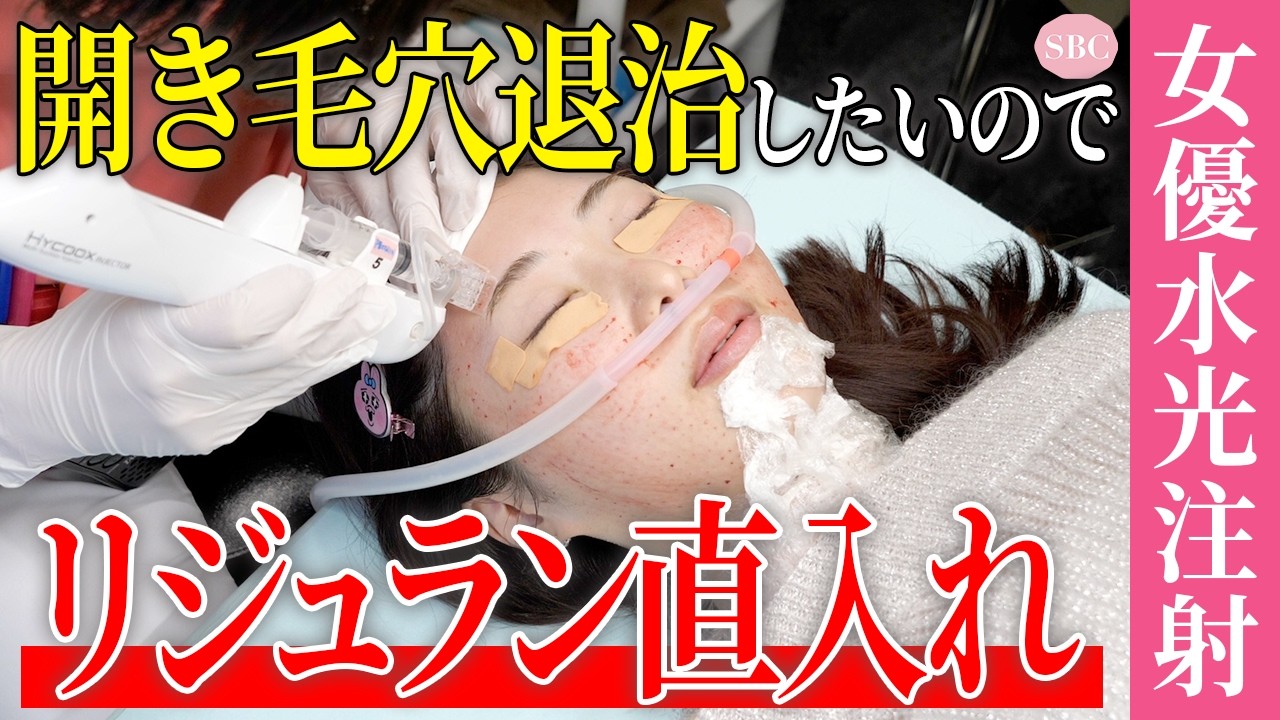 【最強毛穴レス】美肌リジュラン＋ボトックスを全顔に打つ女優水光注射が強い【ツヤ肌育成】湘南美容クリニック
