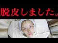 【閲覧注意】私、脱皮しました・・・