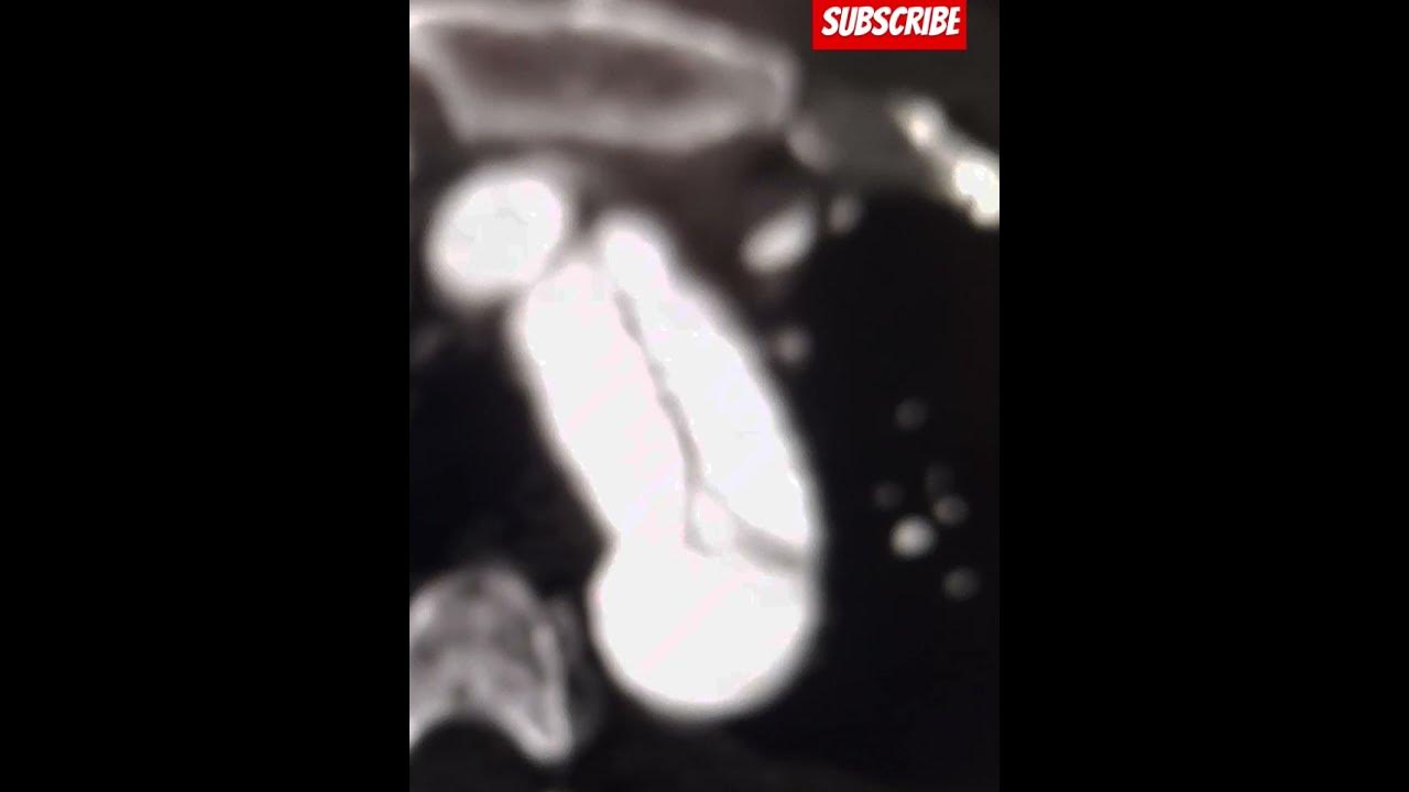 Type A Dissection Surgery