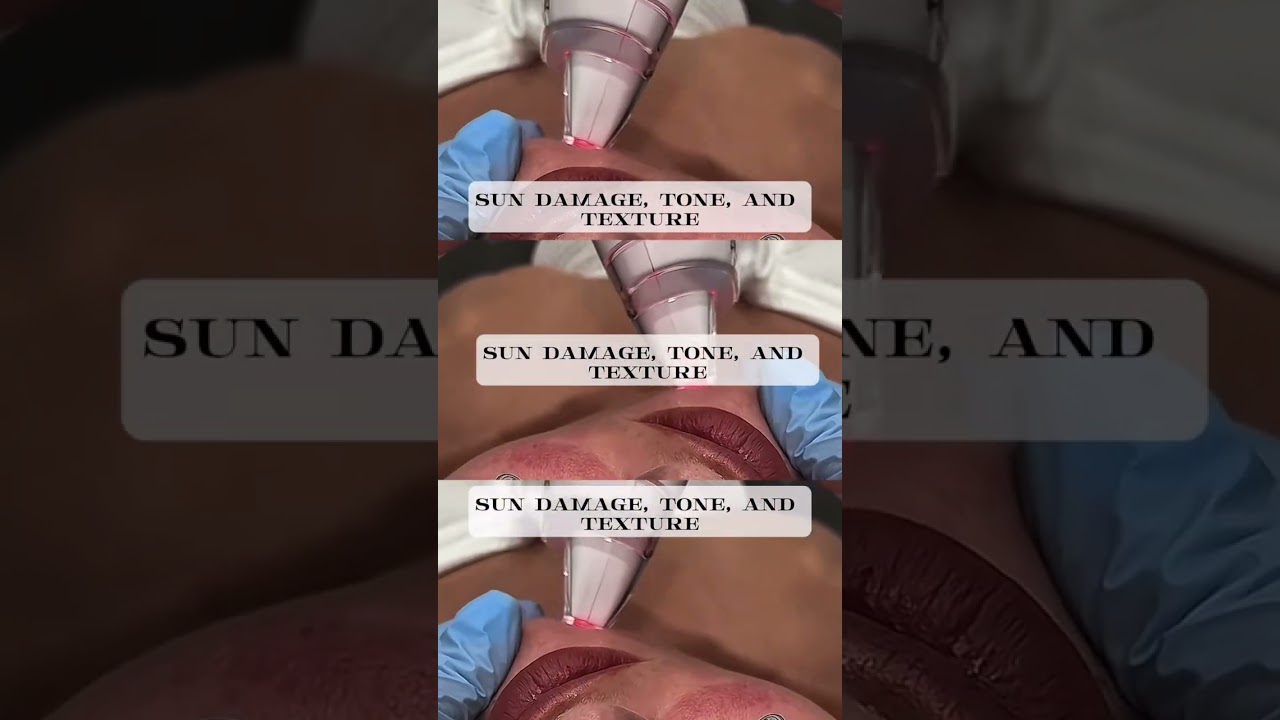 ✨ The Secret to Flawless Skin ✨ Ultra Laser is your post-summer reset 💆‍♀️ 🍂 Fades sun damage &