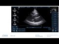 GE Vivid IQ Echo Measurement Training Video