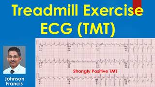 Treadmill Exercise ECG