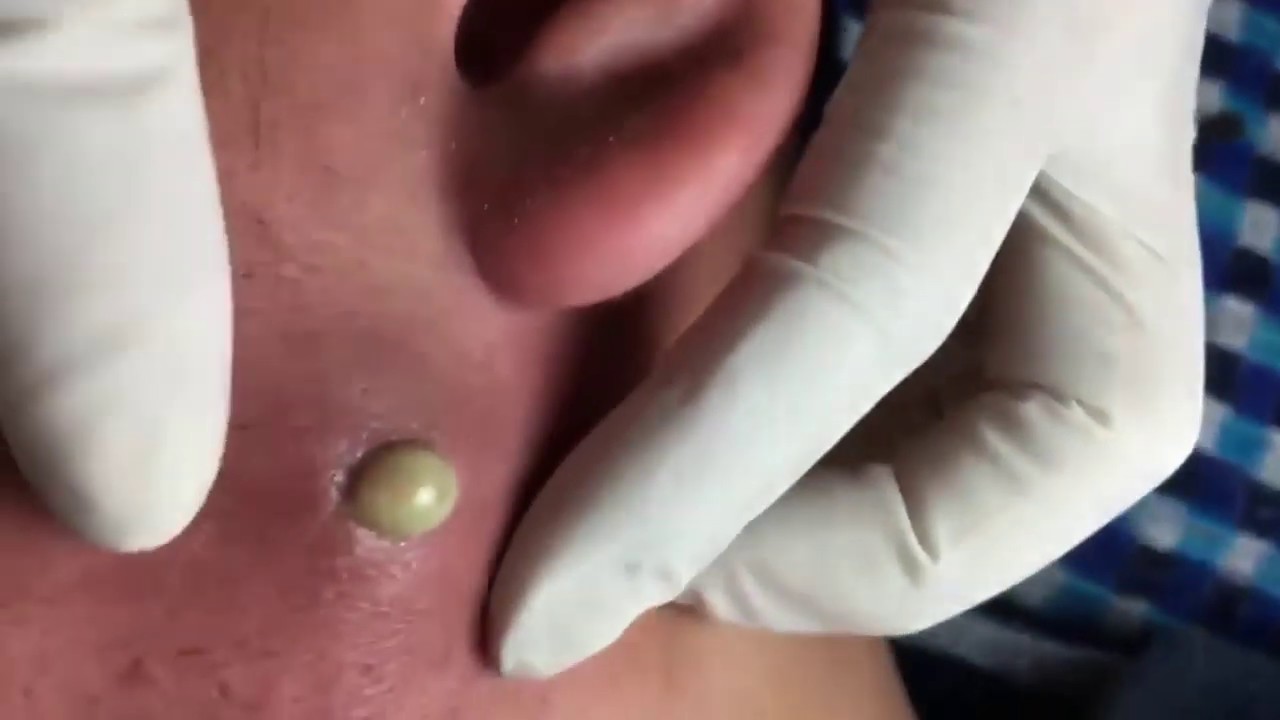 The cyst removal - YouTube