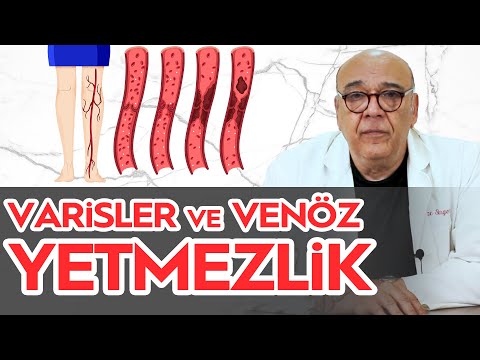 15 Dakikada Kolay Varis Tedavisi | Varis Nedir? Neden Oluşur? / 5 Dakikada Sağlık