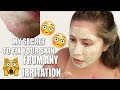 GET RID OF SKIN RASHES ON FACE | Allergic reaction