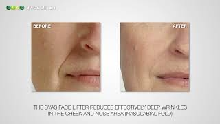 Sensational Results with BYAS FACE LIFTER