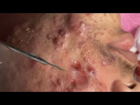 WOW huge cystic acne extraction and blackhead removal process