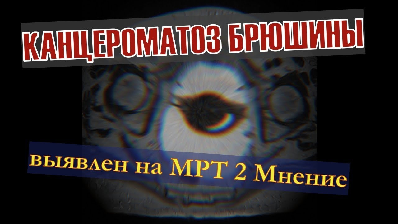 Обнаружены КАНЦЕРОМАТОЗ БРЮШИНЫ и ПРОЛАПС органов малого таза на МРТ ...