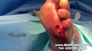 Plantar Wart and Scar Tissue - Dr. Timothy Young