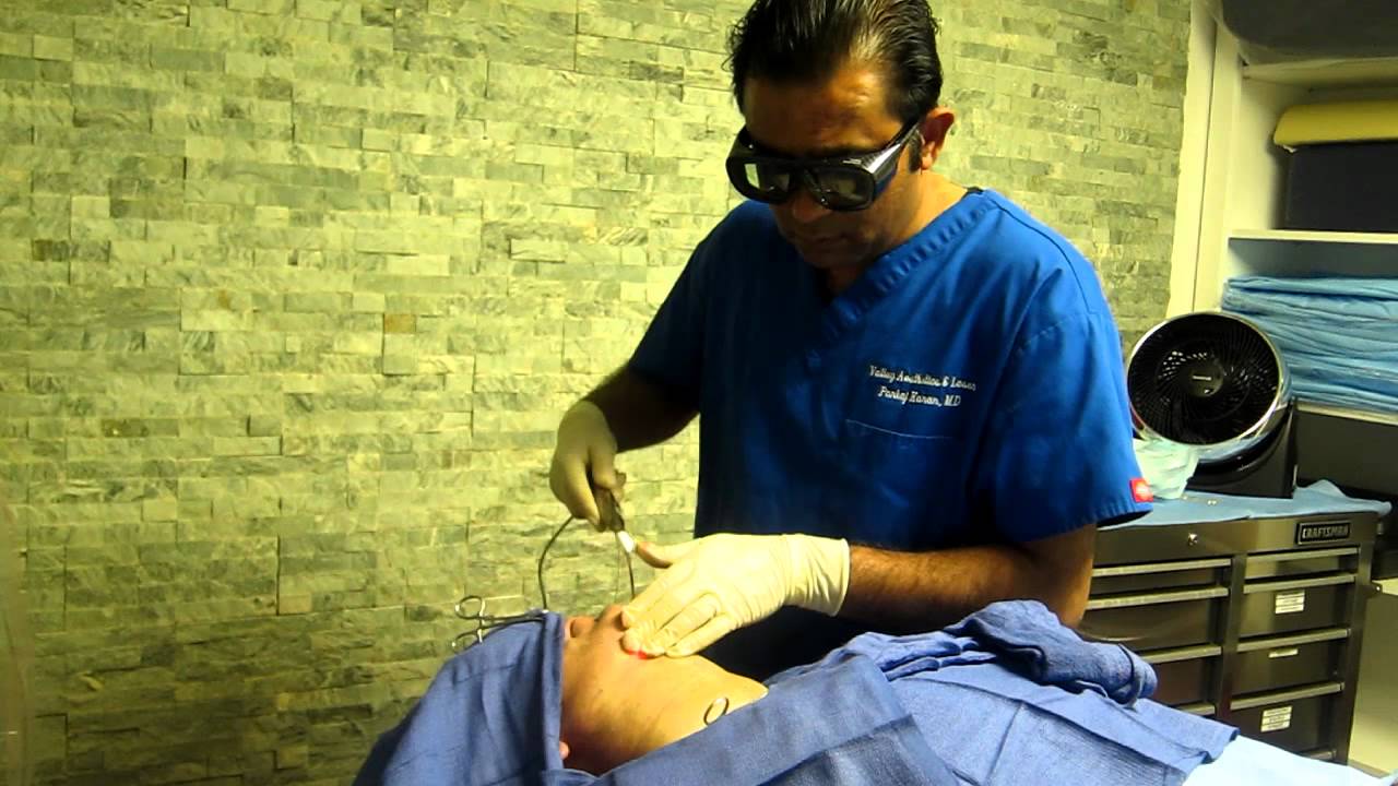 Laser LiposuctionDouble ChinJowlJawlineNeckWhittierLa HabraBrea