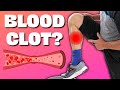 Is Your Calf Pain a Blood Clot!? Do Homan's Test and Find Out.