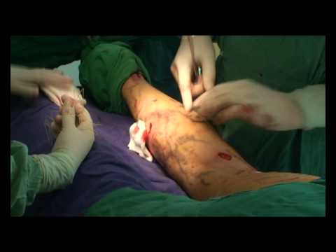 varicoza contraceptive orale
