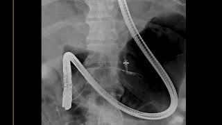 Pancreaticopleural fistula
Speaker: Dr. Mahan Mathur, MD.
Associate Professor, Division of Body Imaging,
Vice Chair of Education, Dept of Radiology and Biomedical Imaging,
Yale University School of Medicine Pancreaticopleural fistula