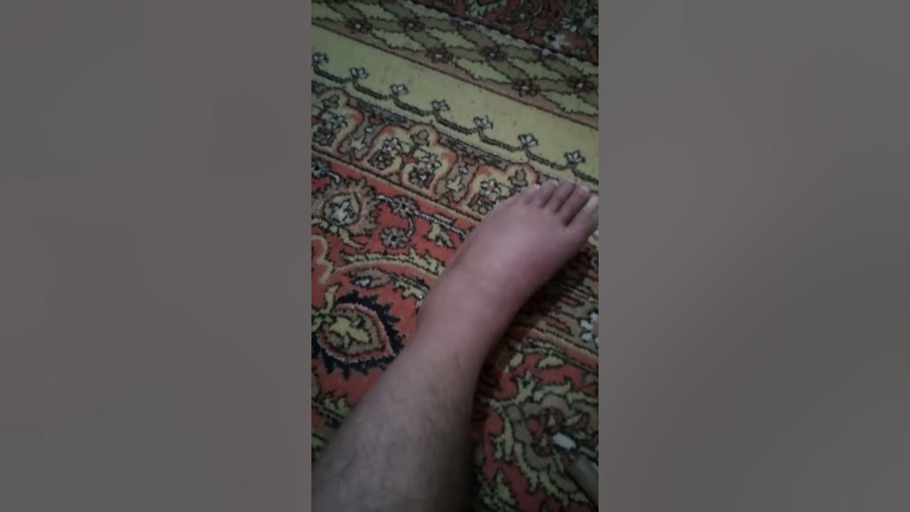 Перелом лодыжки. Нога после снятия гипса. - YouTube