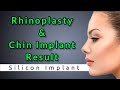 Rhinoplasty   chin implant result  dr jayanta bain plastic surgeon