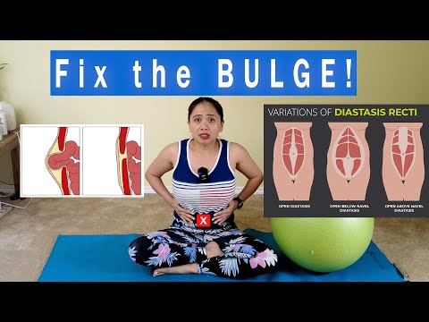 Diastasis Recti Postpartum Umbilical Hernia Pilates Dumbbell