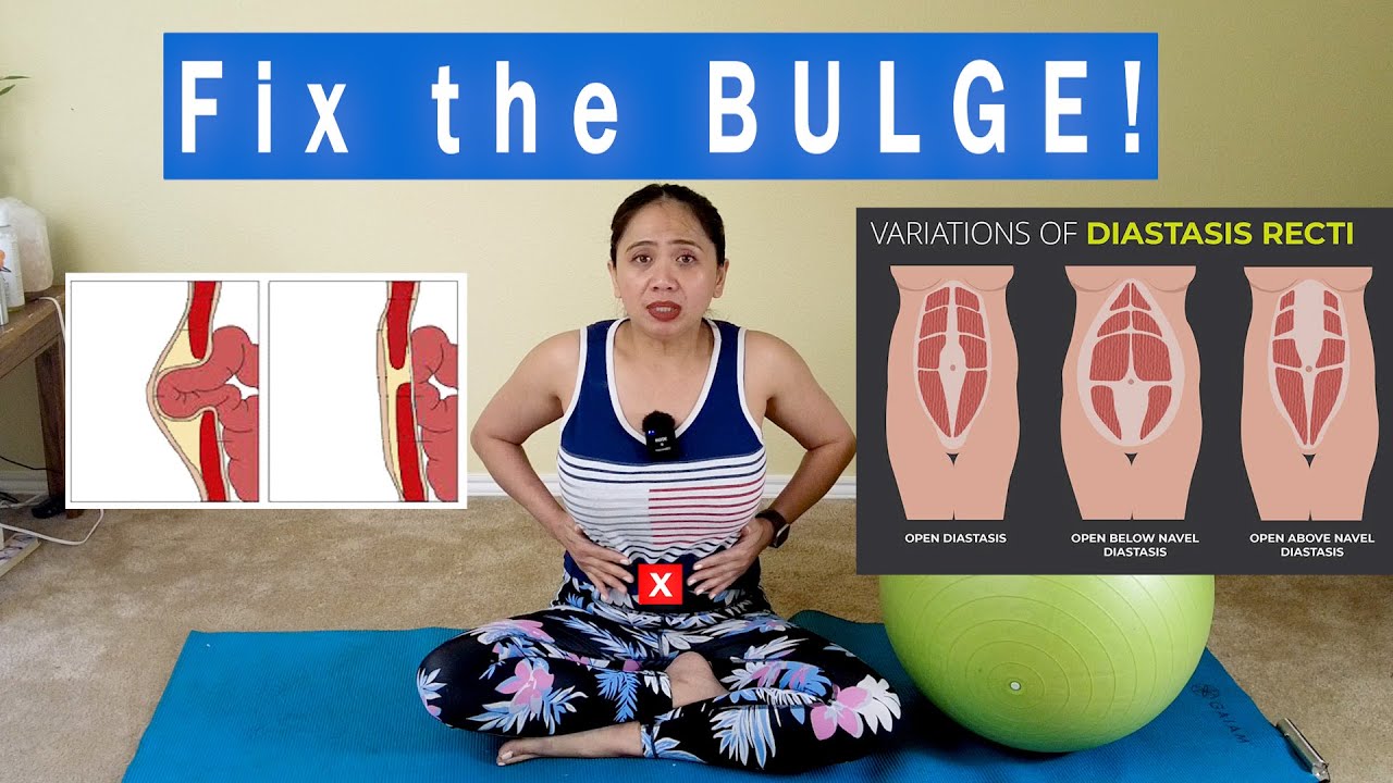 5 BEST Ways And Exercises to Fix the BULGE for GOOD! Abs Separation due to  Hernia Diastasis Recti 