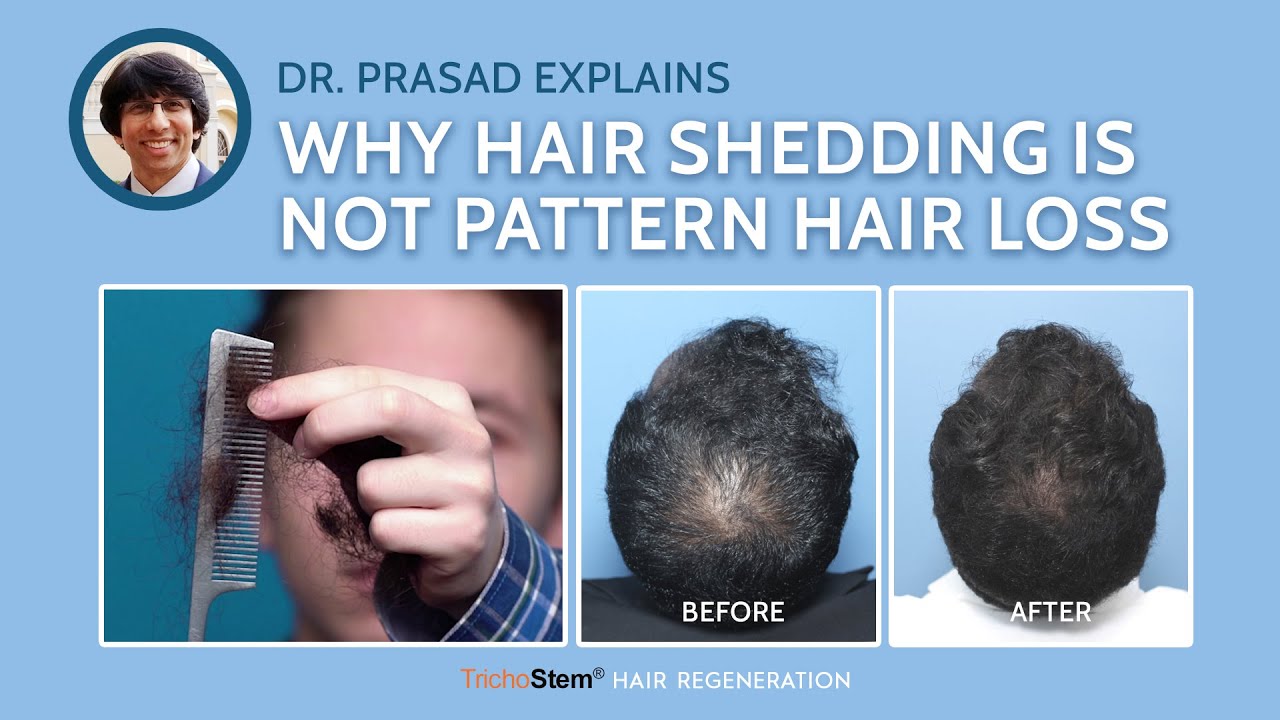 Update more than 73 hair shedding vs hair loss