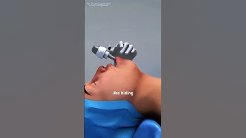 How Thyroidectomy Is Done (3D animation) #music #motivation #epic #like