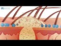 Animation: SalSphere® Even Skin / SalSphere® Salicylic Acid