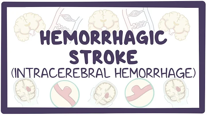 Hemorrhagic stroke: intracerebral hemorrhage - causes, symptoms, diagnosis, treatment, pathology - DayDayNews