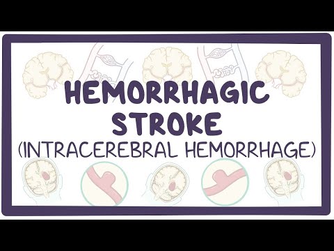 Hemorrhagic stroke: intracerebral hemorrhage – causes, symptoms, diagnosis, treatment, pathology