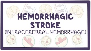 Hemorrhagic stroke: intracerebral hemorrhage  causes, symptoms, diagnosis, treatment, pathology