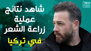 نتائج عملية زراعة الشعر في تركيا | السيد عوض من فلسطين | مشفى فيرا كلينيك