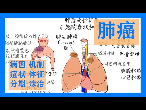 USMLE：Lung  cancer animation a photographic memory  | 漫画记忆过目不忘【肺癌】的病因、机制、症状体征、诊断、分期和治疗