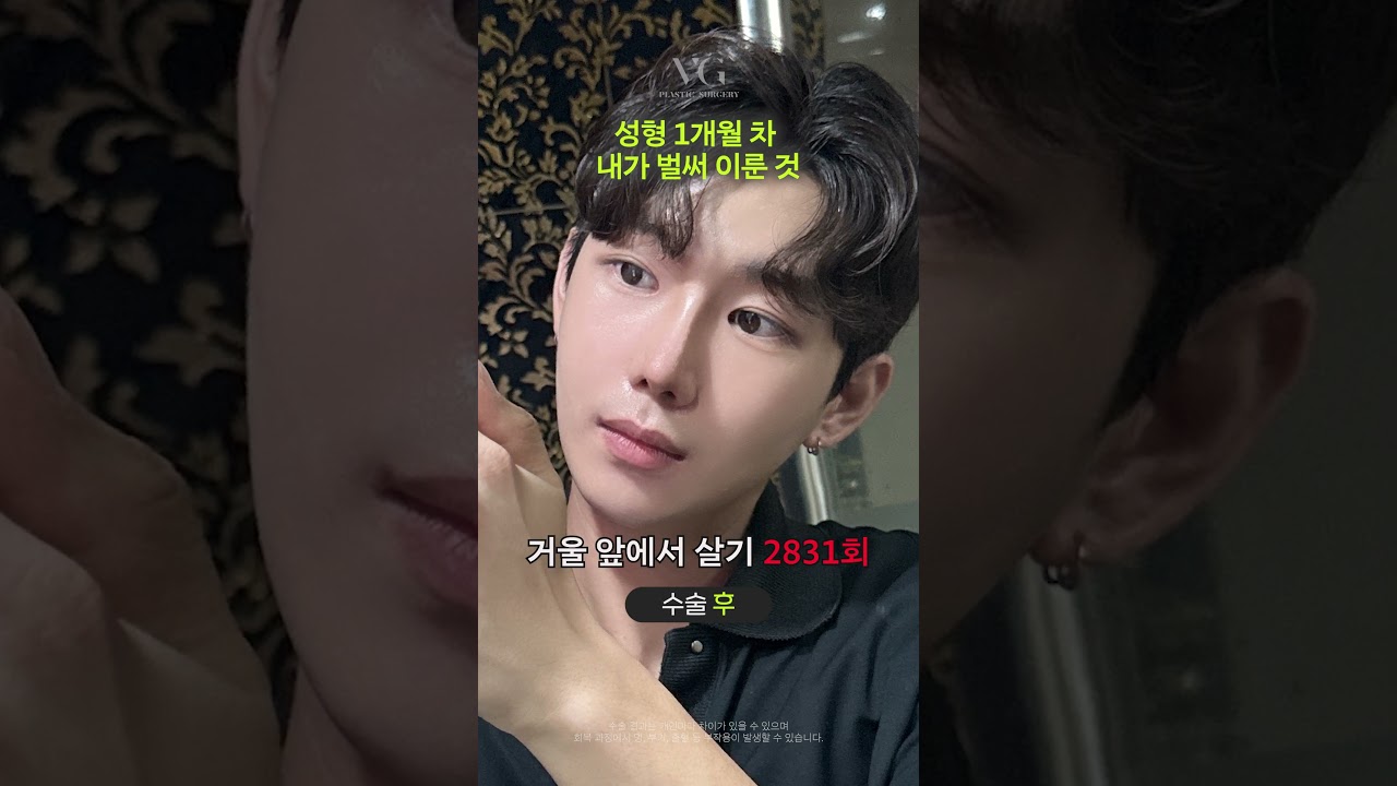 [維麗好整形外科診所] 眼鼻輪廓整形，短短一個月內我所達成的成就