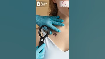 Skin Cancer Signs - ABCDE Rule to be watchful for - Dr. Rajdeep Mysore| Doctors