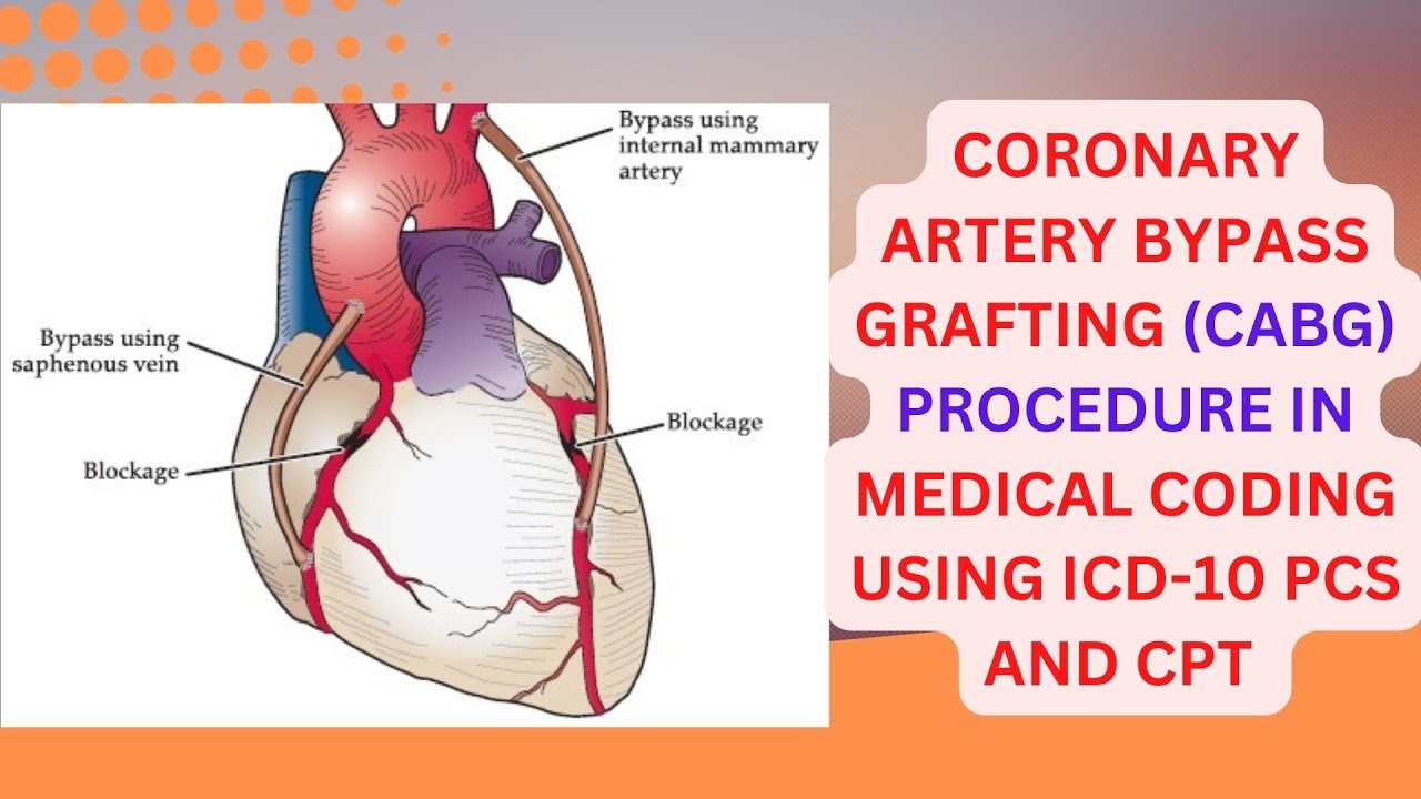 CORONARY ARTERY BYPASS GRAFTING (CABG) CODING IN ICD10 PCS AND CPT