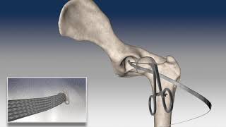 Hip Subluxation with NOVALIG®