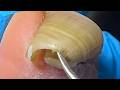 Extremely Long Ingrown Toenails,The Patient Has Not Had A Pedicure For 4 Months【Xue Yidao】
