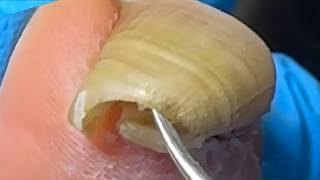 Extremely Long Ingrown Toenails,The Patient Has Not Had A Pedicure For 4 Months【Xue Yidao】