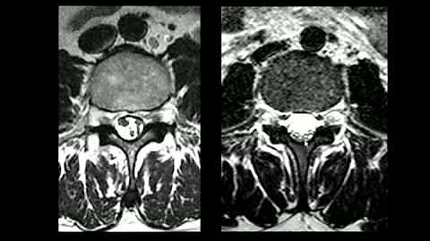 O que causa a aracnoidite adesiva?