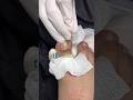 Matricectomia, solución definitiva para uñas encarnadas #ingrown_toenail #satisfying