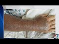 How To Avoid Flesh Eating Bacteria When You Re Out On The Water How To Avoid Flesh Eating Bacteria When You Re Out On The Water