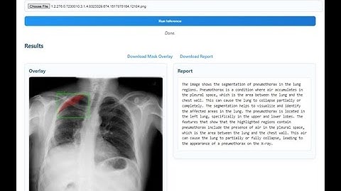 114上_專題成果影片_MultiModel Chest X-Ray Pneumothorax Detection and Report Generation System
